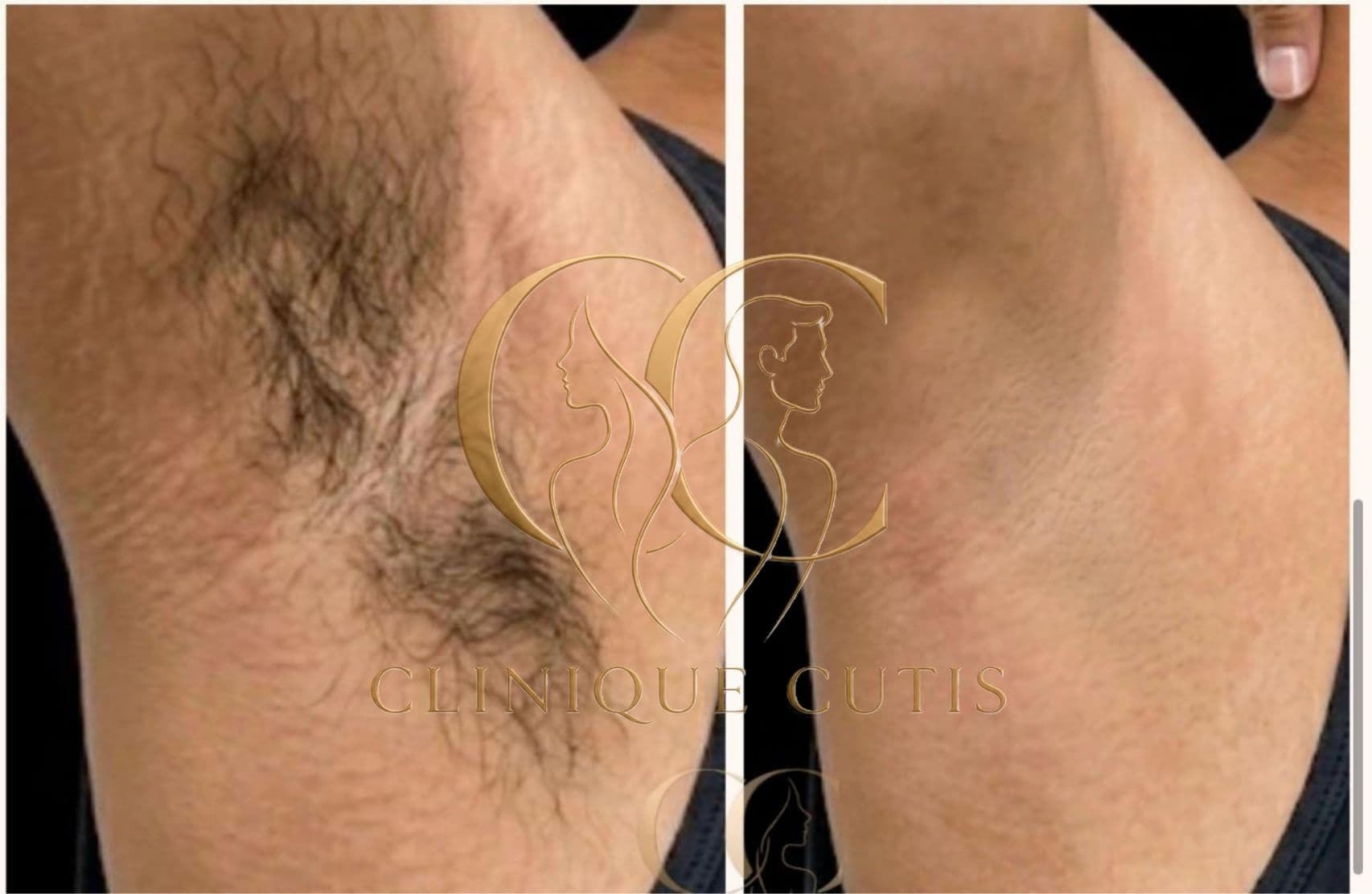 Laser Hair Removal