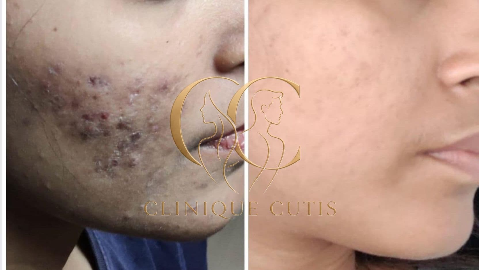 Cystic Acne Treatment