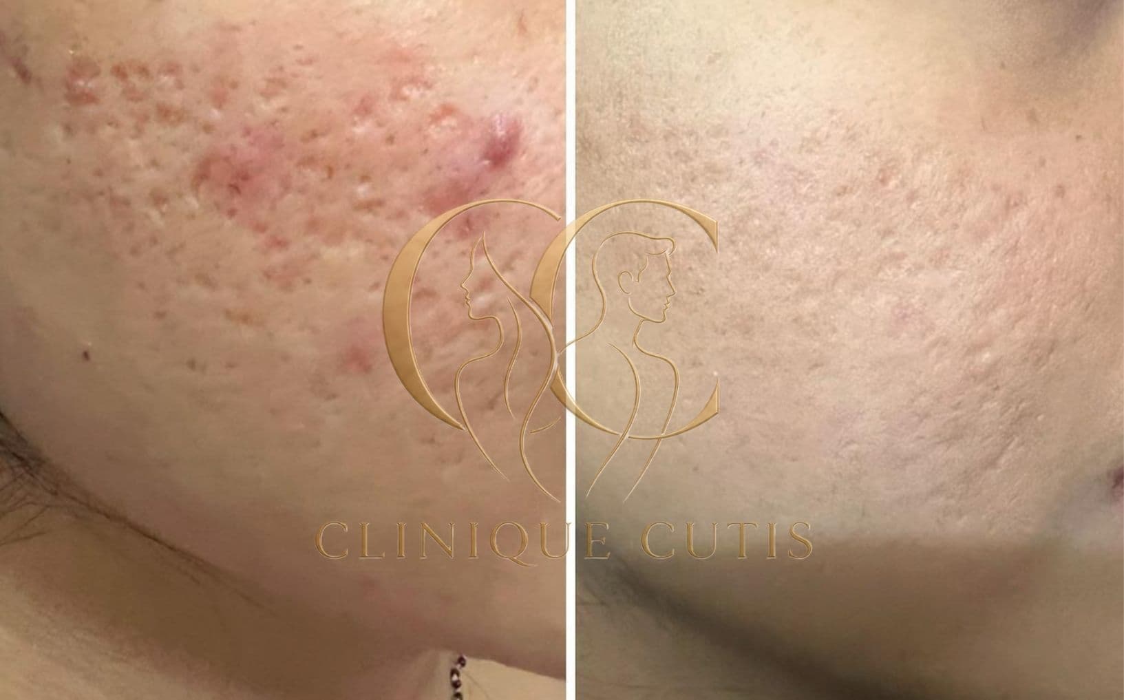 Acne Scar Treatment