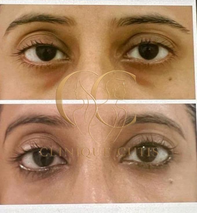 Dark Circle Treatment