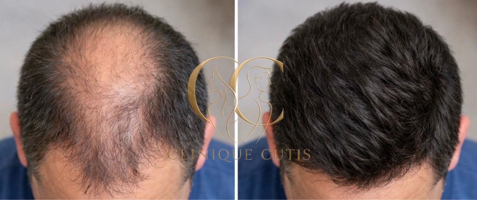 Hair Restoration