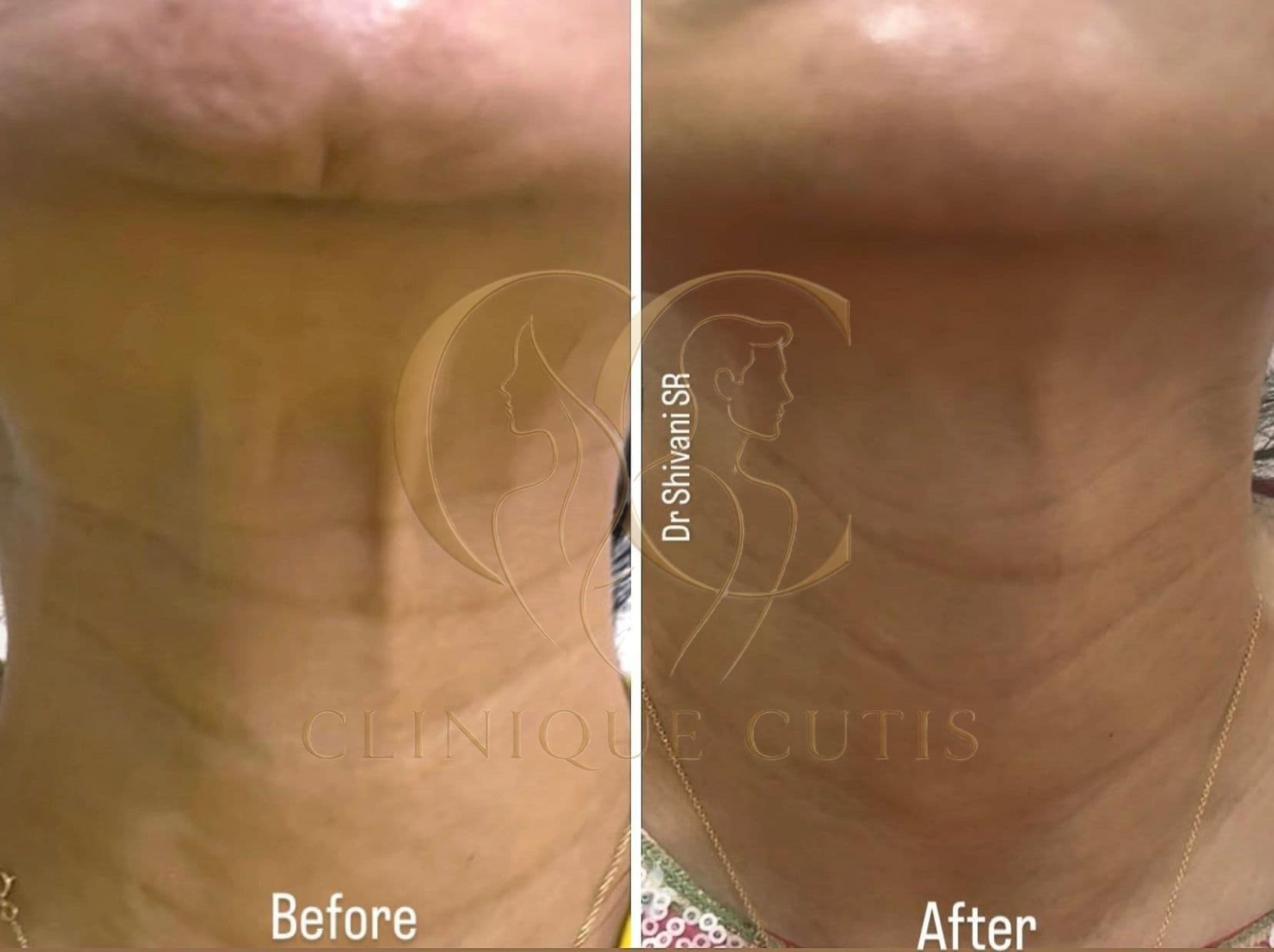 Neck Rejuvenation