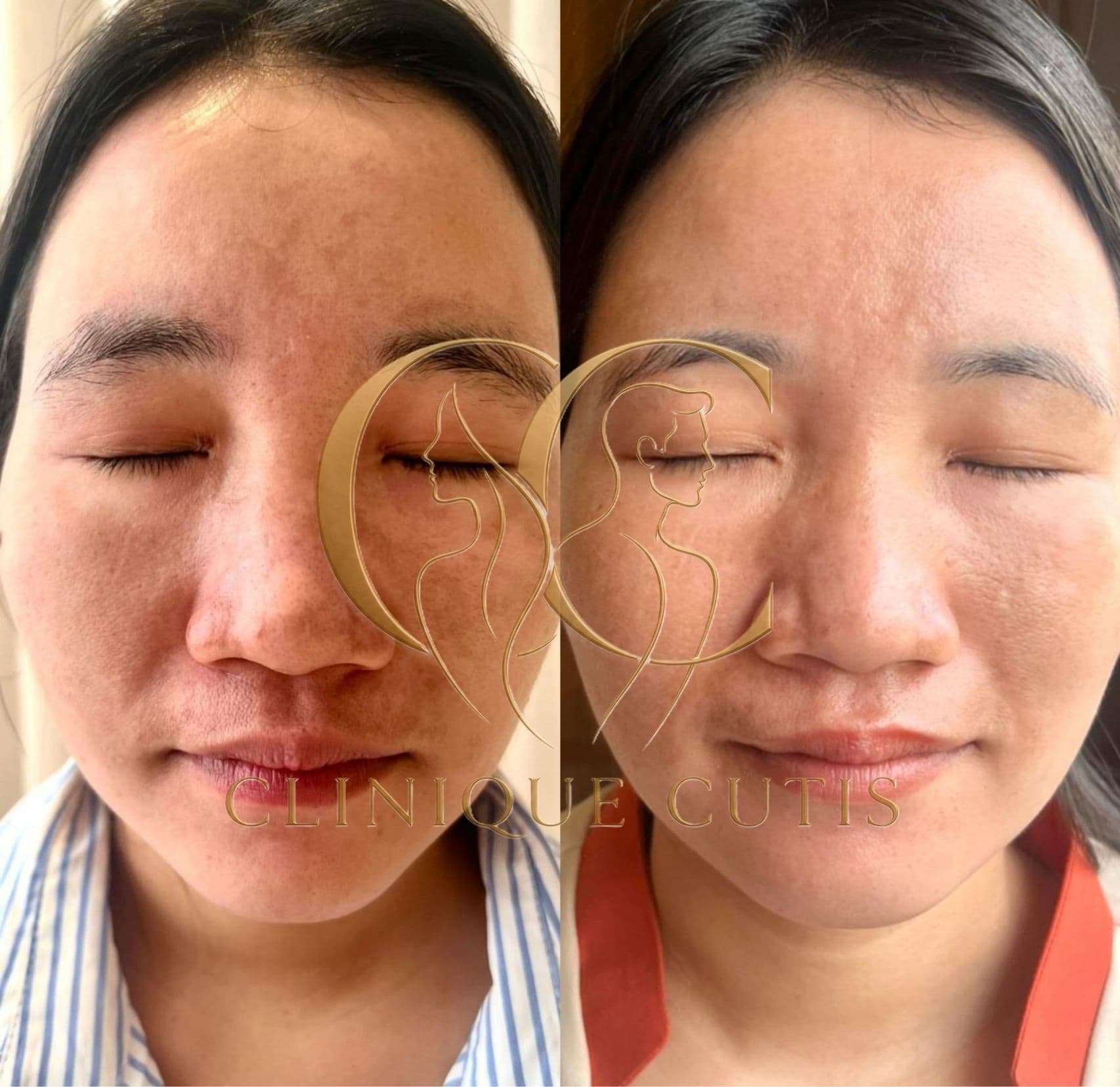 Pigmentation Treatment