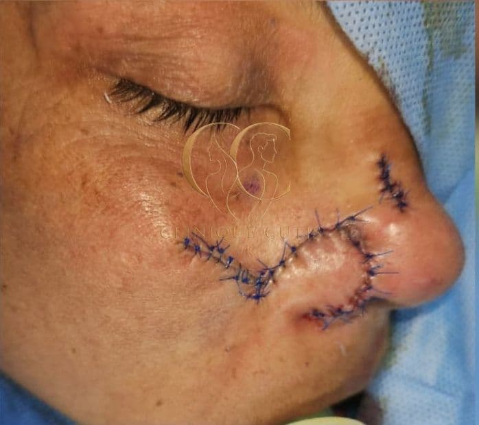 Basal Cell Carcinoma After