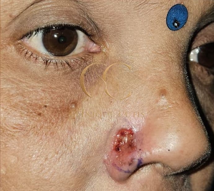 Basal Cell Carcinoma Before