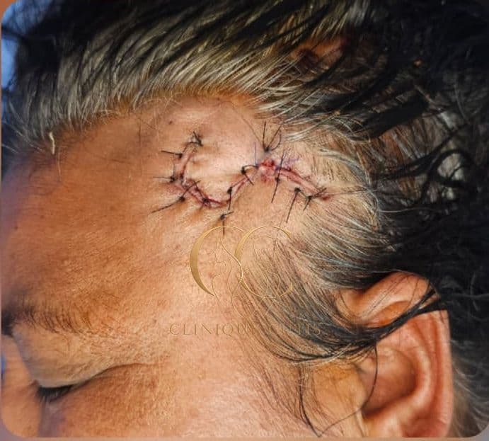 Basal Cell Carcinoma After