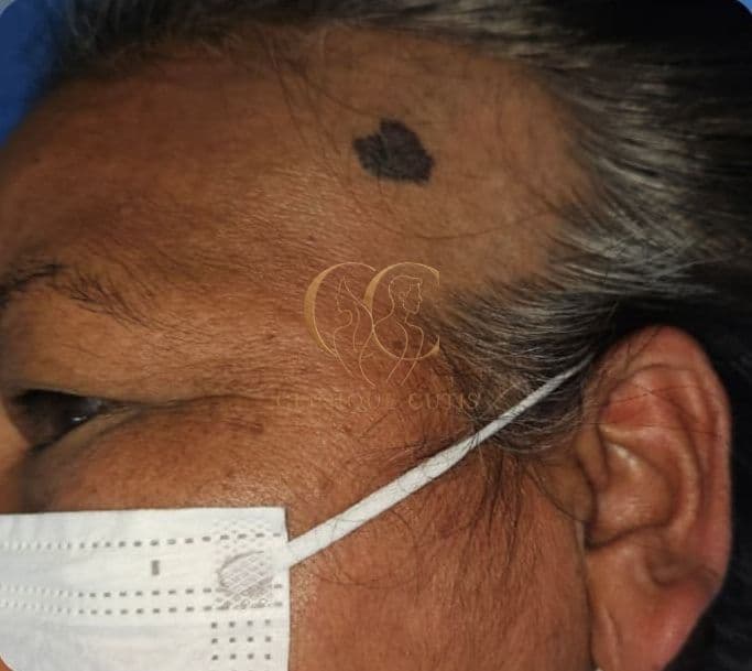 Basal Cell Carcinoma Before