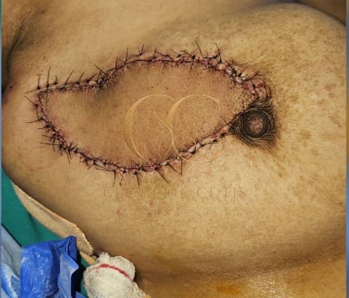 Breast Cancer After