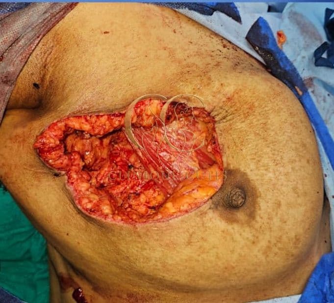 Breast Cancer Before