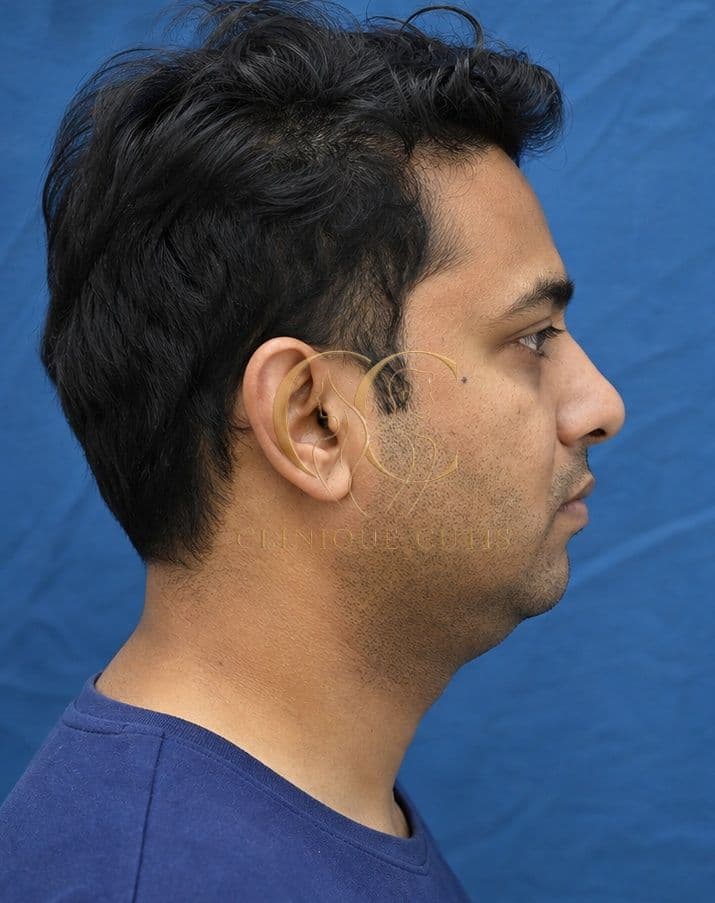 Chin Implant Before