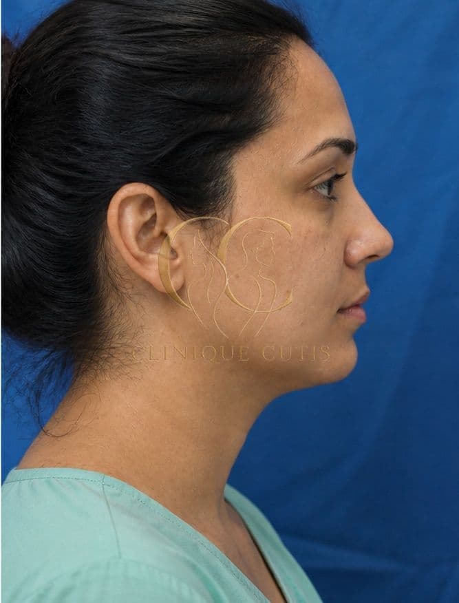 Chin Implant After