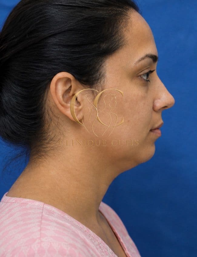 Chin Implant Before