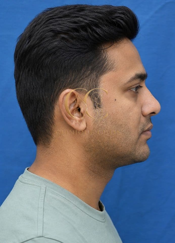 Chin Implant After