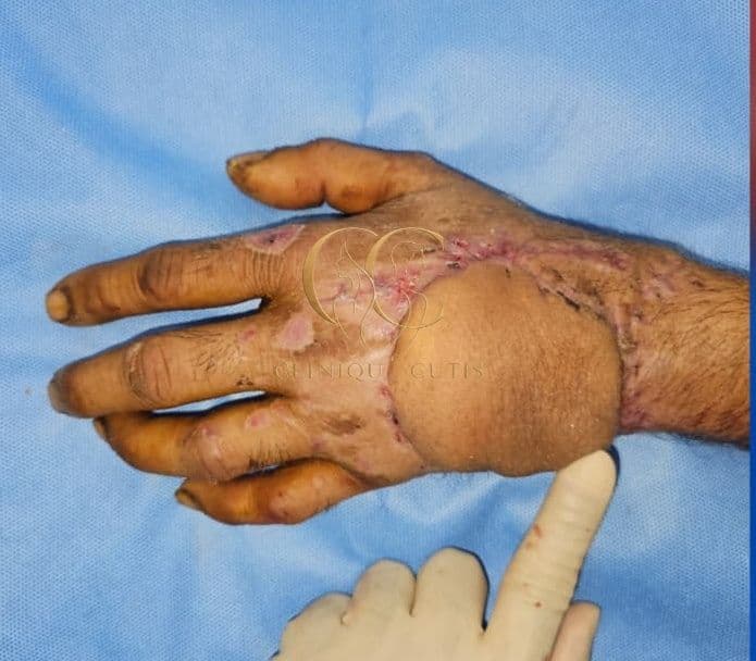 Complex Hand Defect After