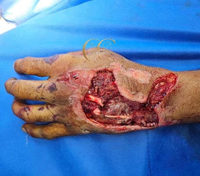 Complex Hand Defect Before