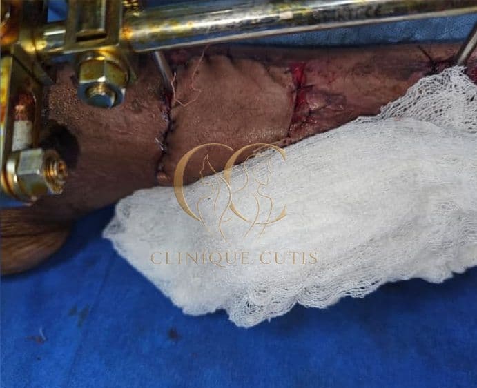 Complex Leg Defect After