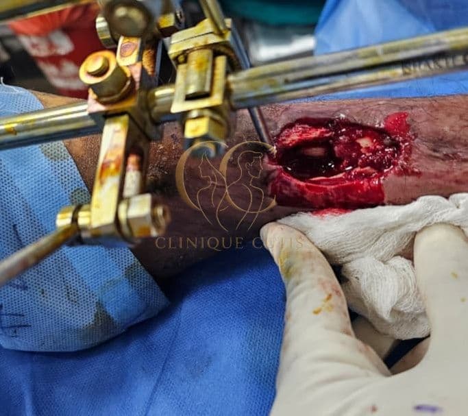 Complex Leg Defect Before