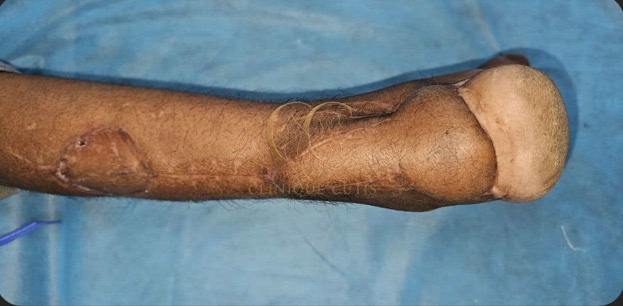 Complex Leg Defect After