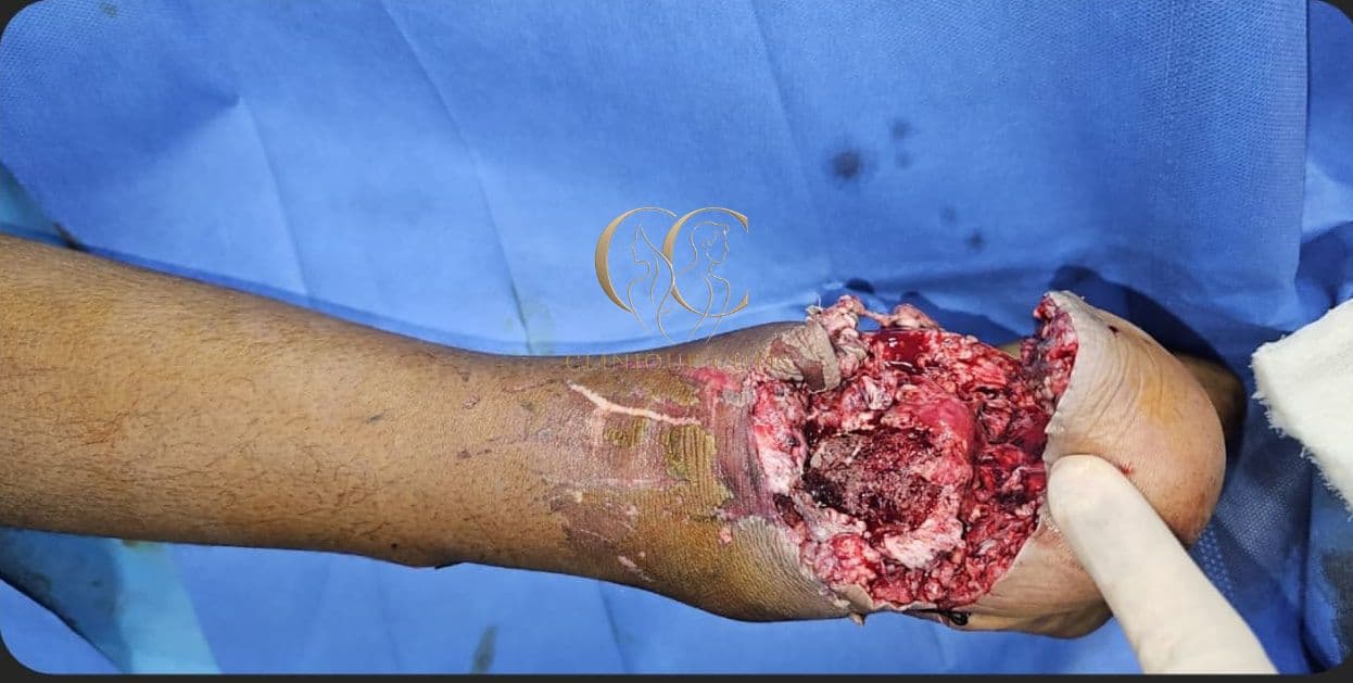Complex Leg Defect Before