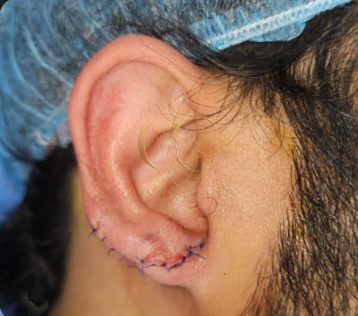 Ear Injury After