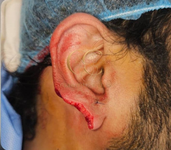 Ear Injury Before
