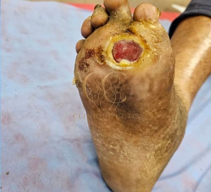 Foot Ulcer Before