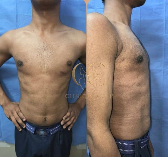 Gynaecomastia After
