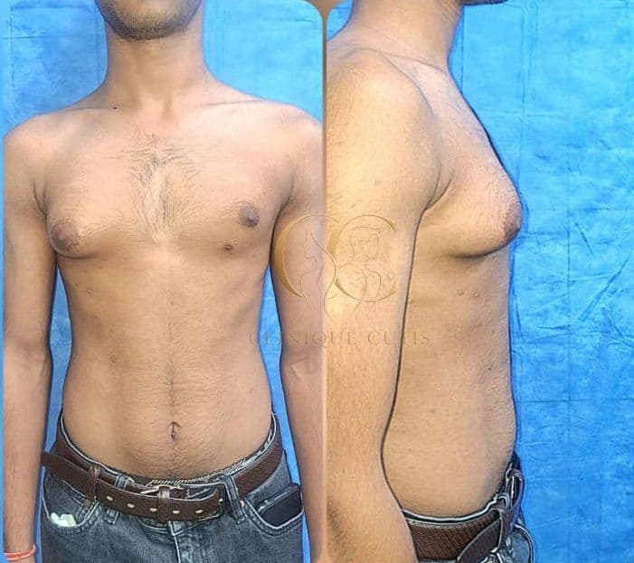 Gynaecomastia Before