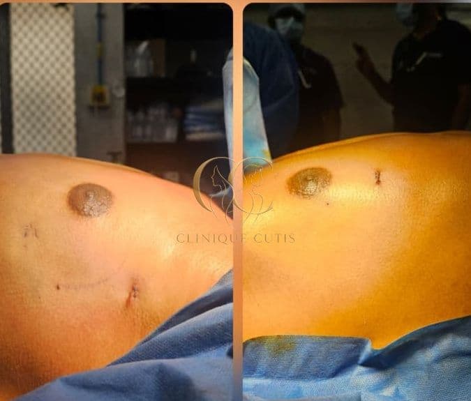 Gynaecomastia After