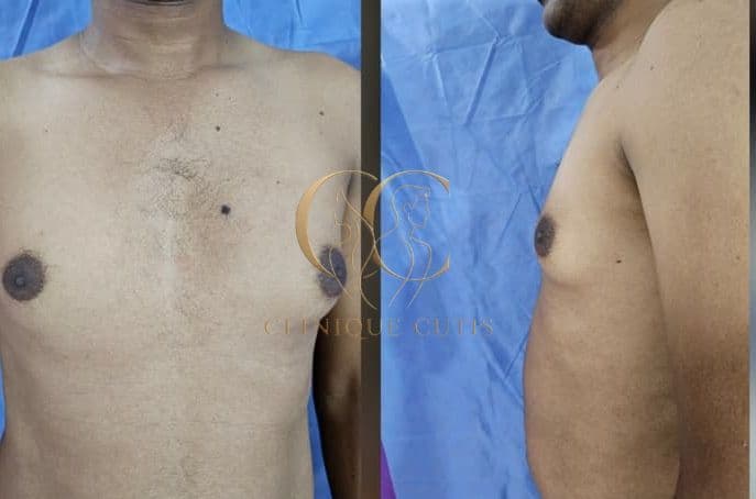 Gynaecomastia Before