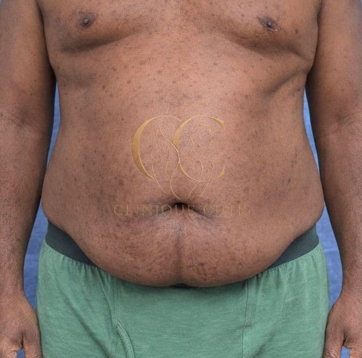HD Liposuction Before