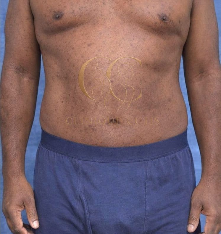 HD Liposuction After
