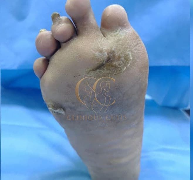Foot Ulcer After