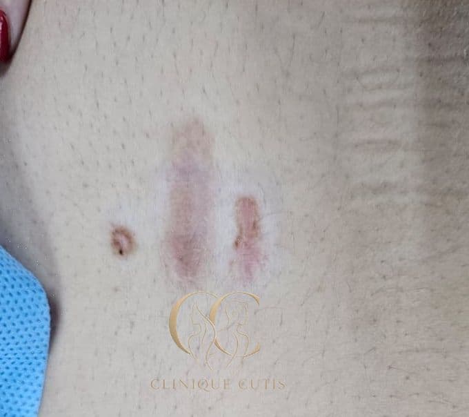 Keloid After