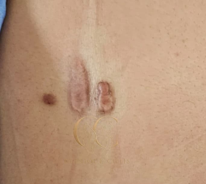 Keloid Before