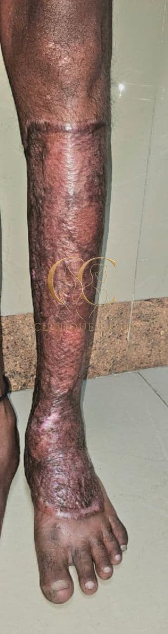 Large Leg Wound After