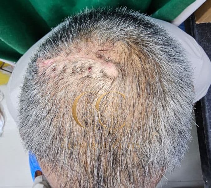 Sebaceous Cyst After