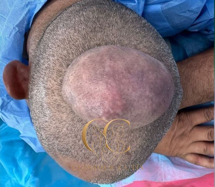 Sebaceous Cyst Before
