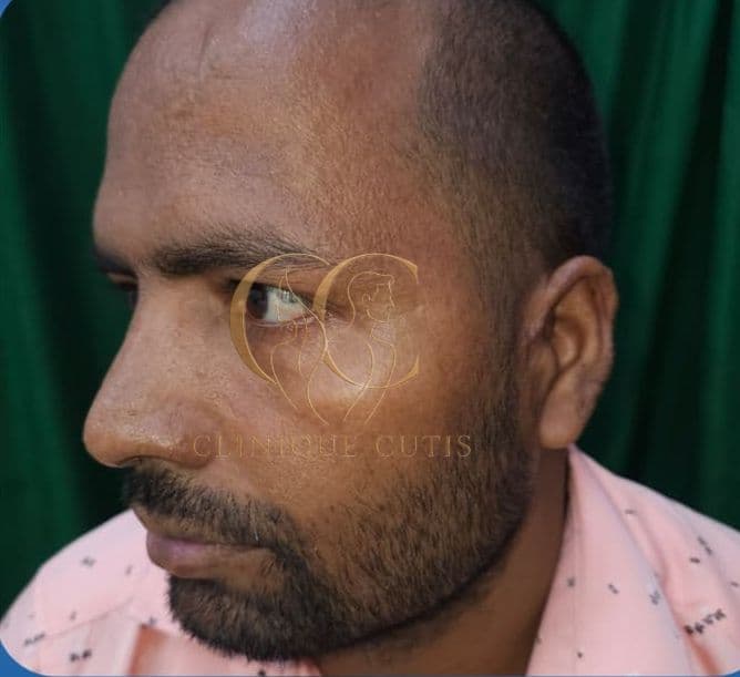 Ear Keloid After