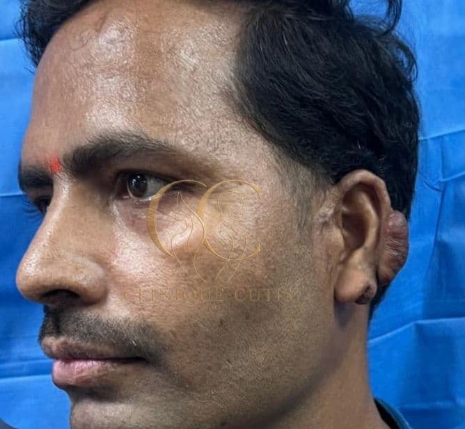 Ear Keloid Before