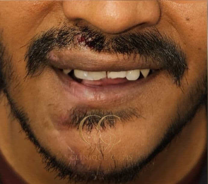 Lip Injury After