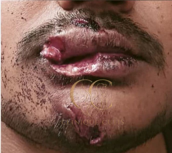 Lip Injury Before