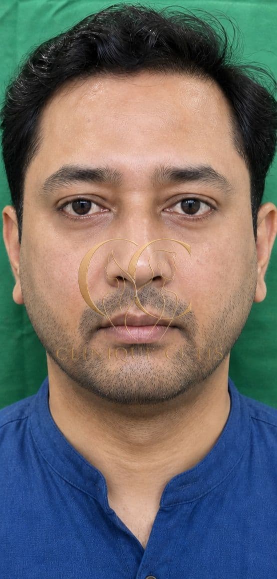 Lower Blepharoplasty After