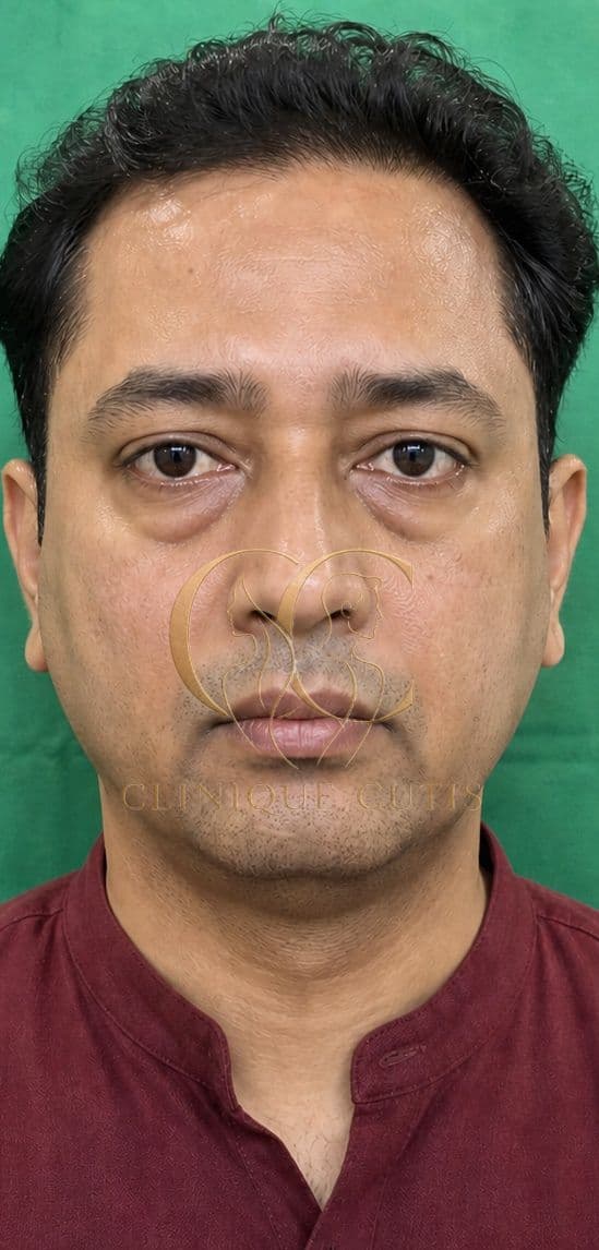 Lower Blepharoplasty Before
