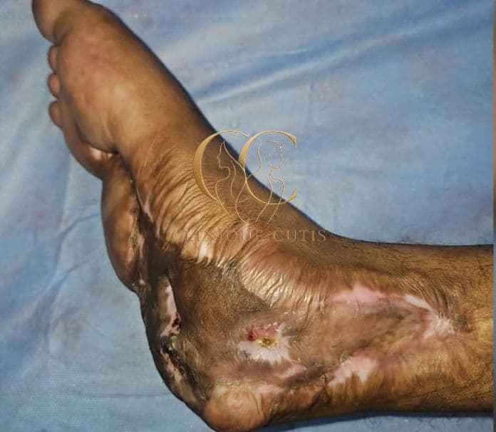 Ankle Ulcer After