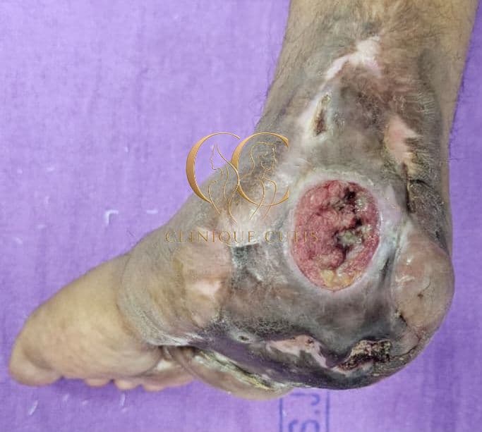 Ankle Ulcer Before