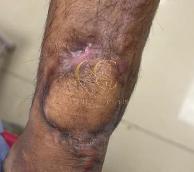 Leg Wound After