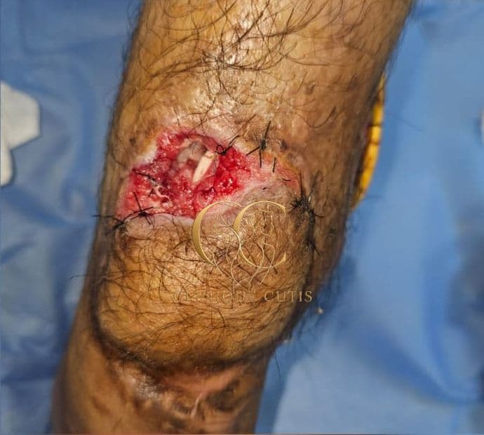 Leg Wound Before