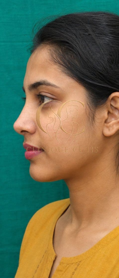 Rhinoplasty After