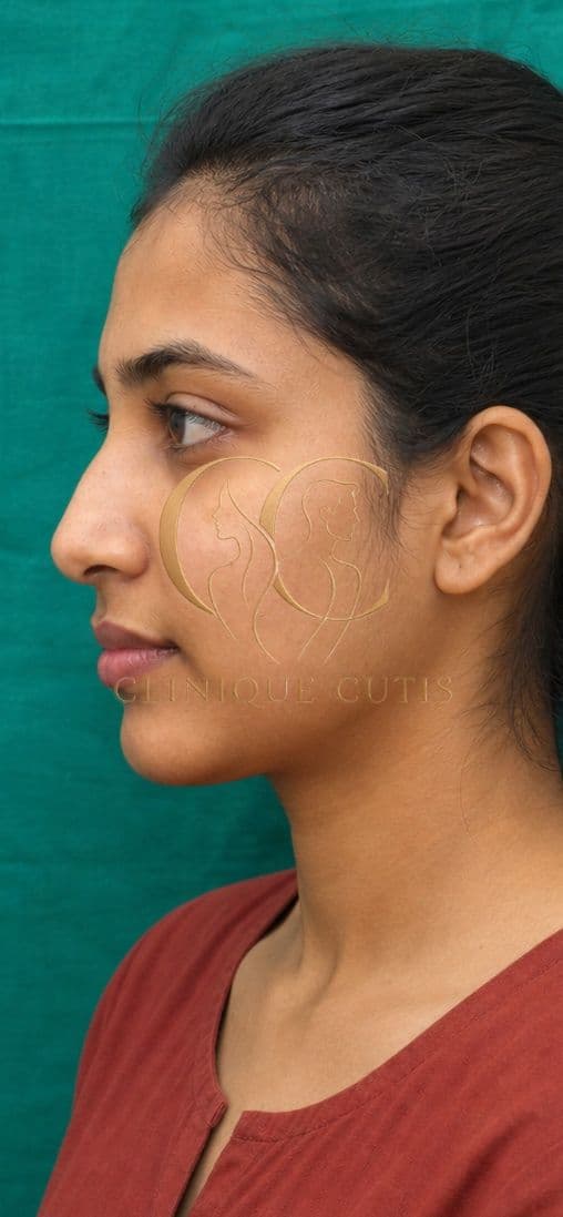 Rhinoplasty Before